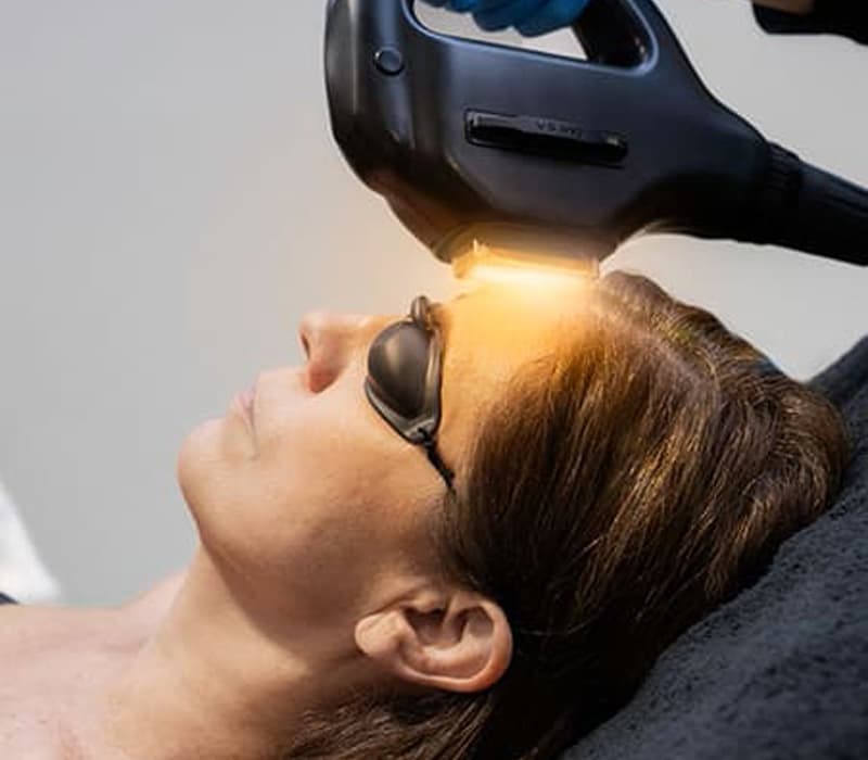 Fotorejuvenecimiento facial FHOS